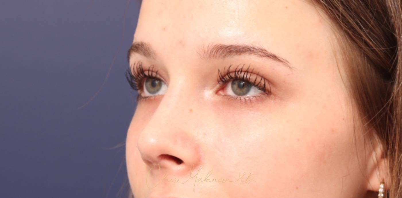 Rhinoplasty Before & After Photo