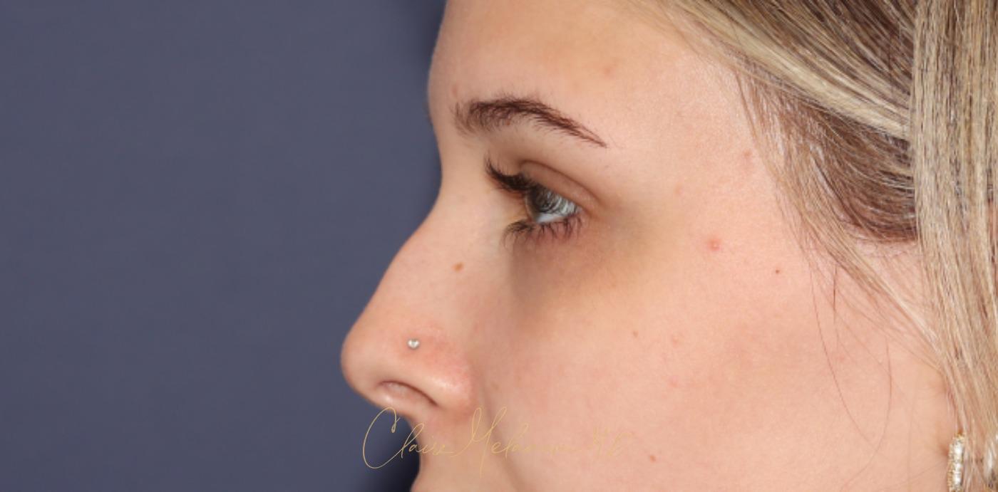 Rhinoplasty Before & After Photo