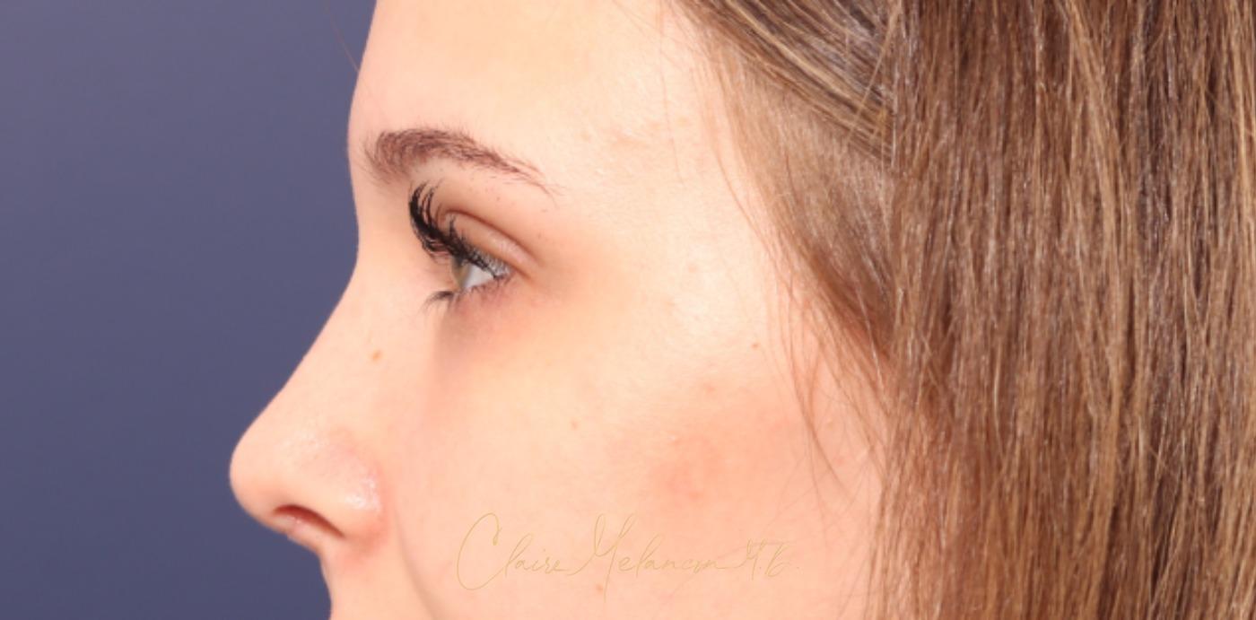 Rhinoplasty Before & After Photo