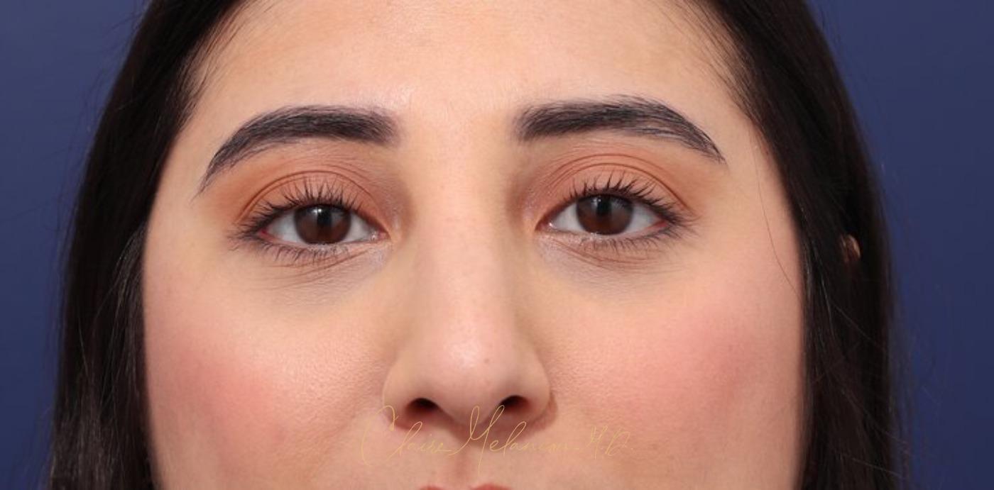 Rhinoplasty Before & After Photo