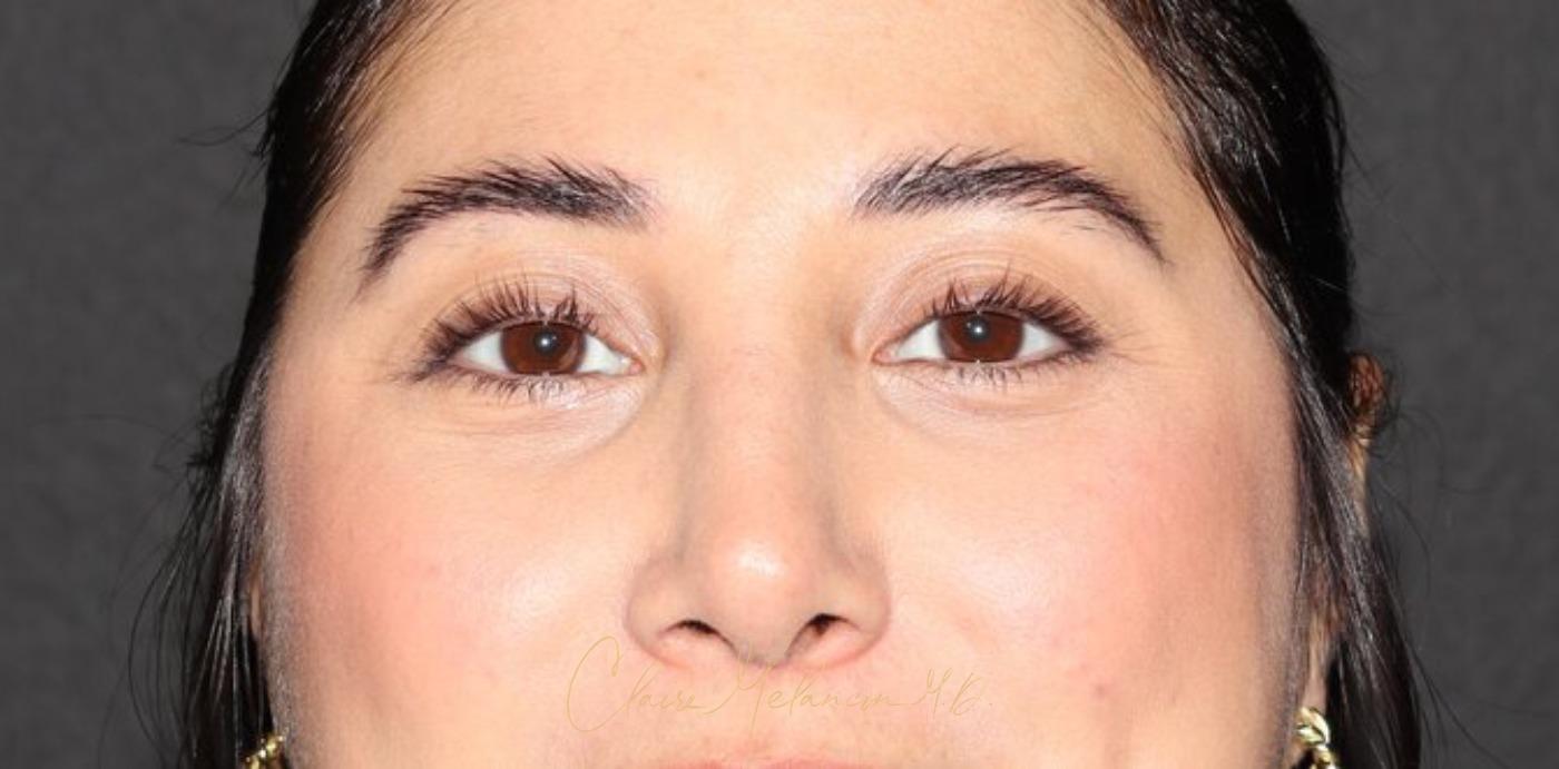 Rhinoplasty Before & After Photo