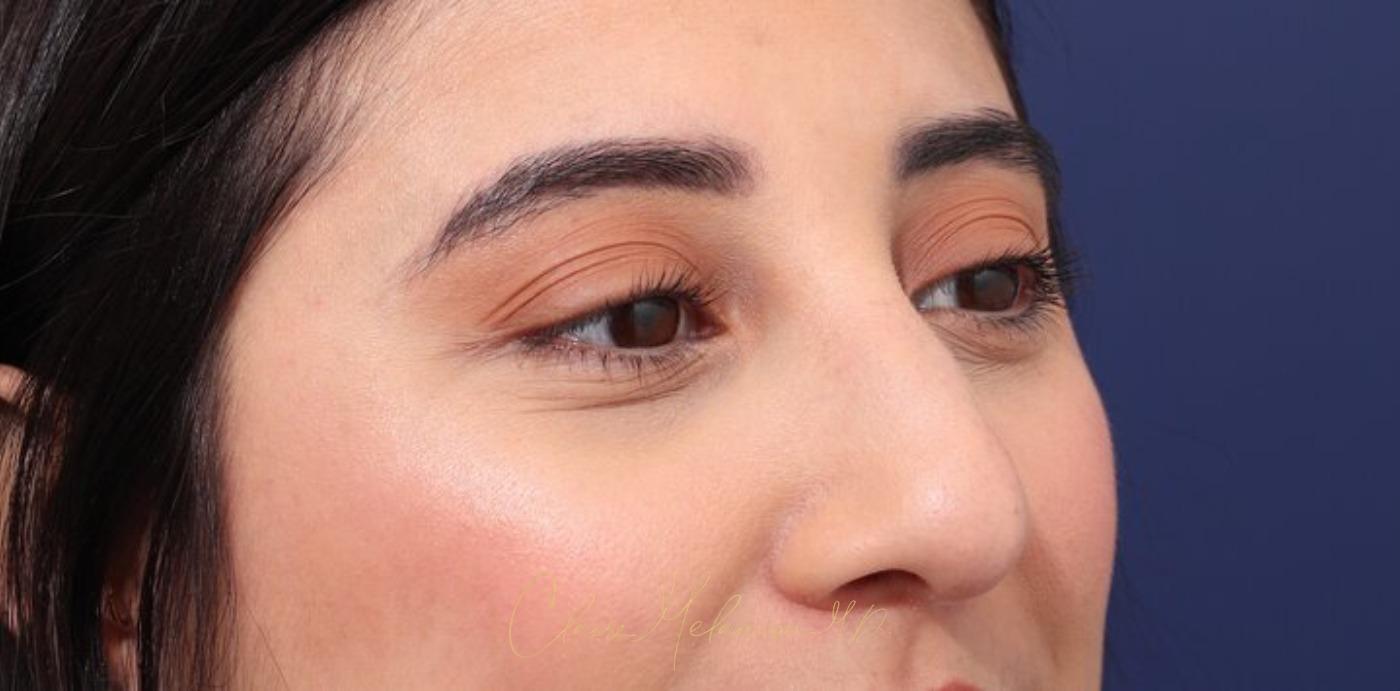 Rhinoplasty Before & After Photo