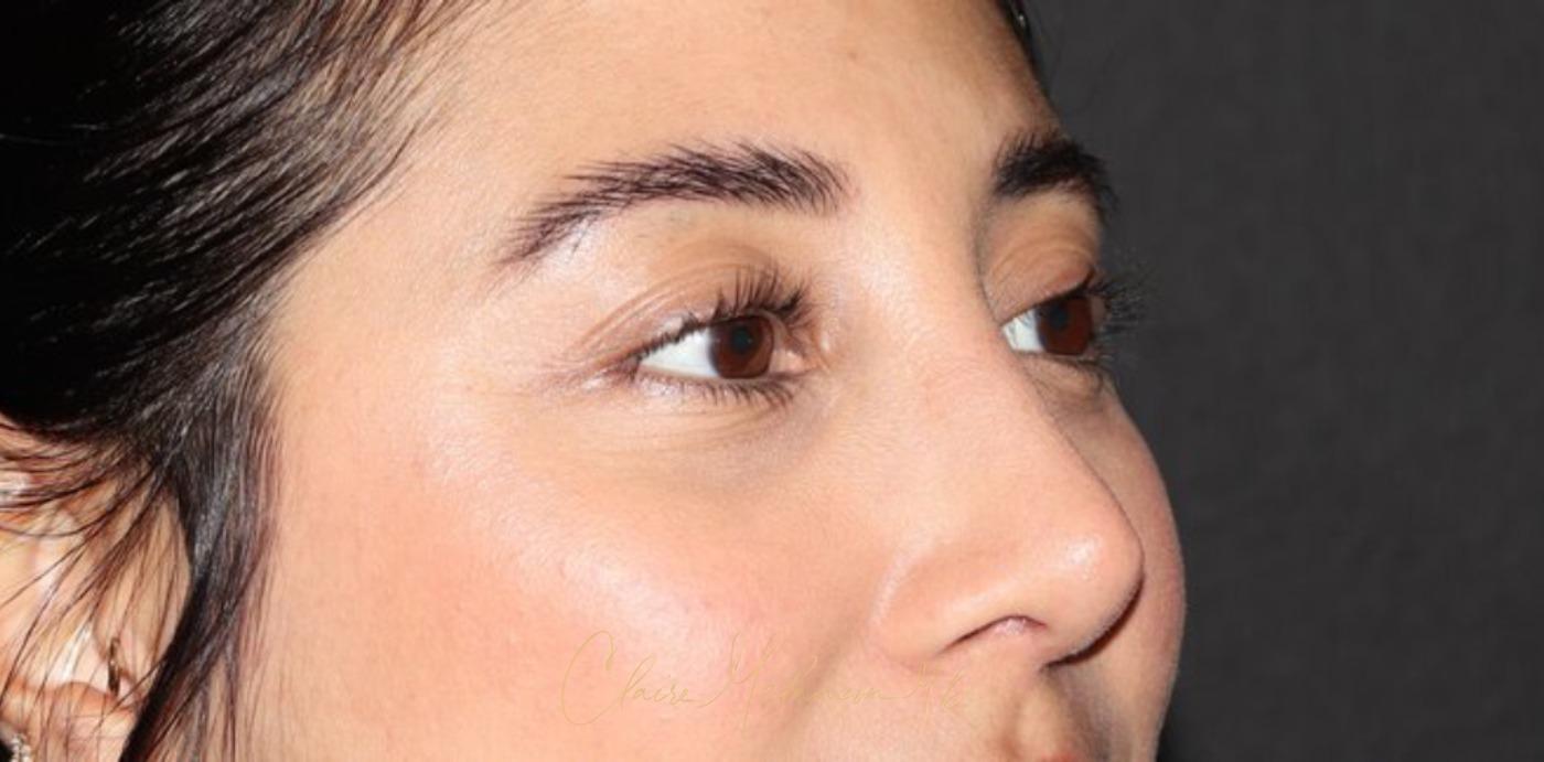 Rhinoplasty Before & After Photo