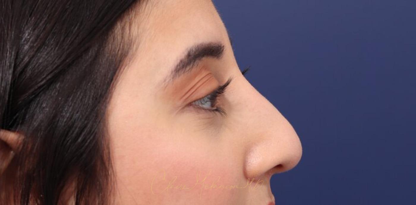 Rhinoplasty Before & After Photo