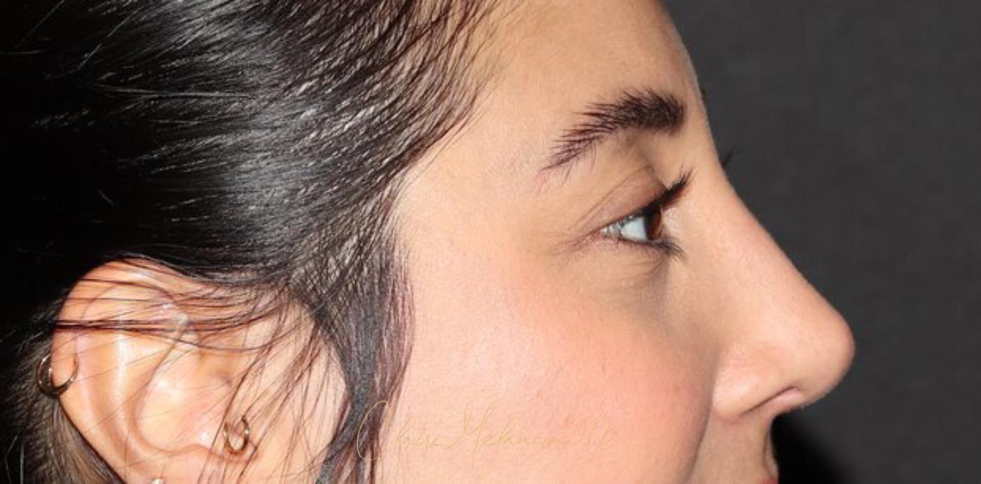 Rhinoplasty Before & After Photo