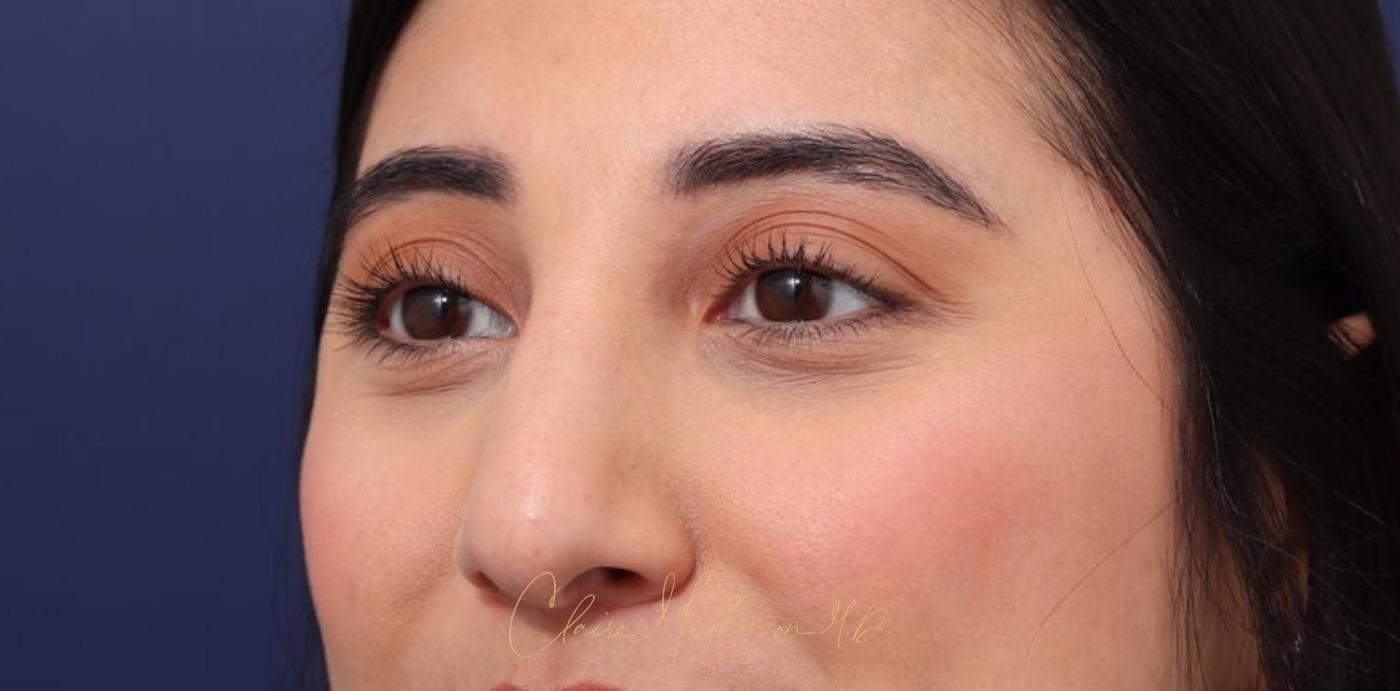 Rhinoplasty Before & After Photo