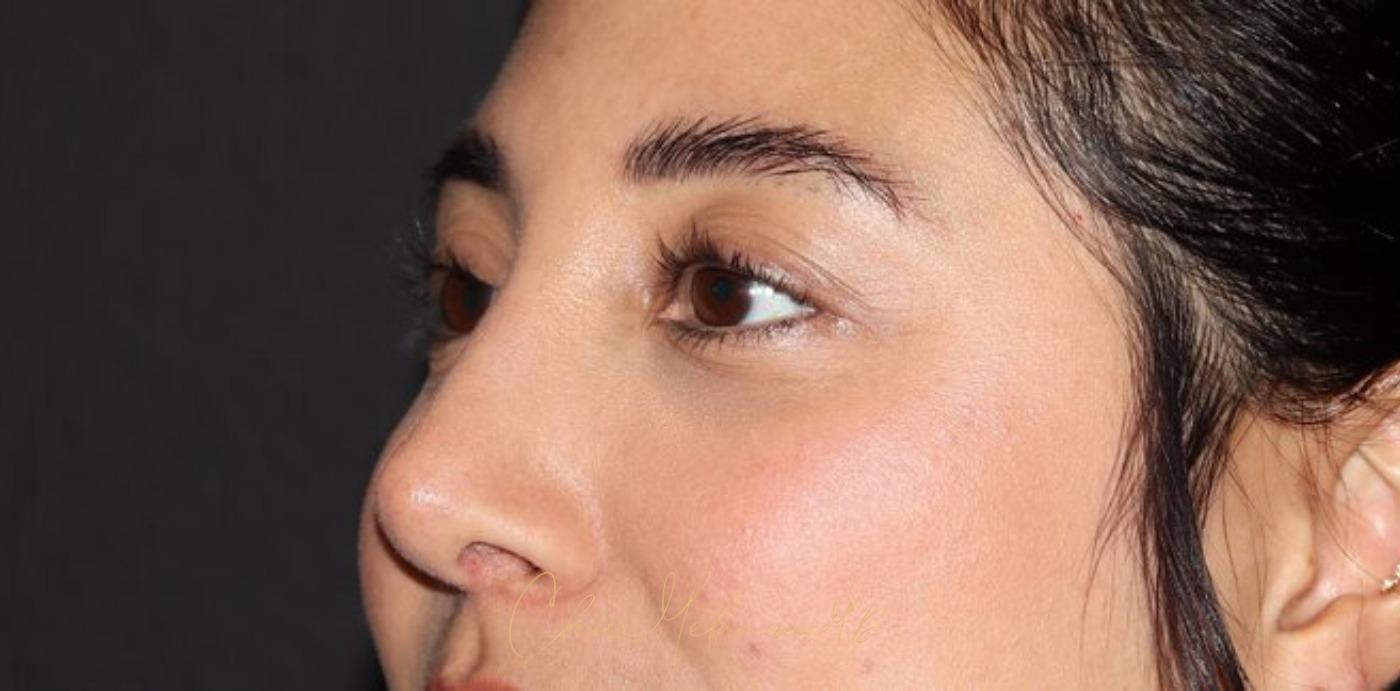 Rhinoplasty Before & After Photo