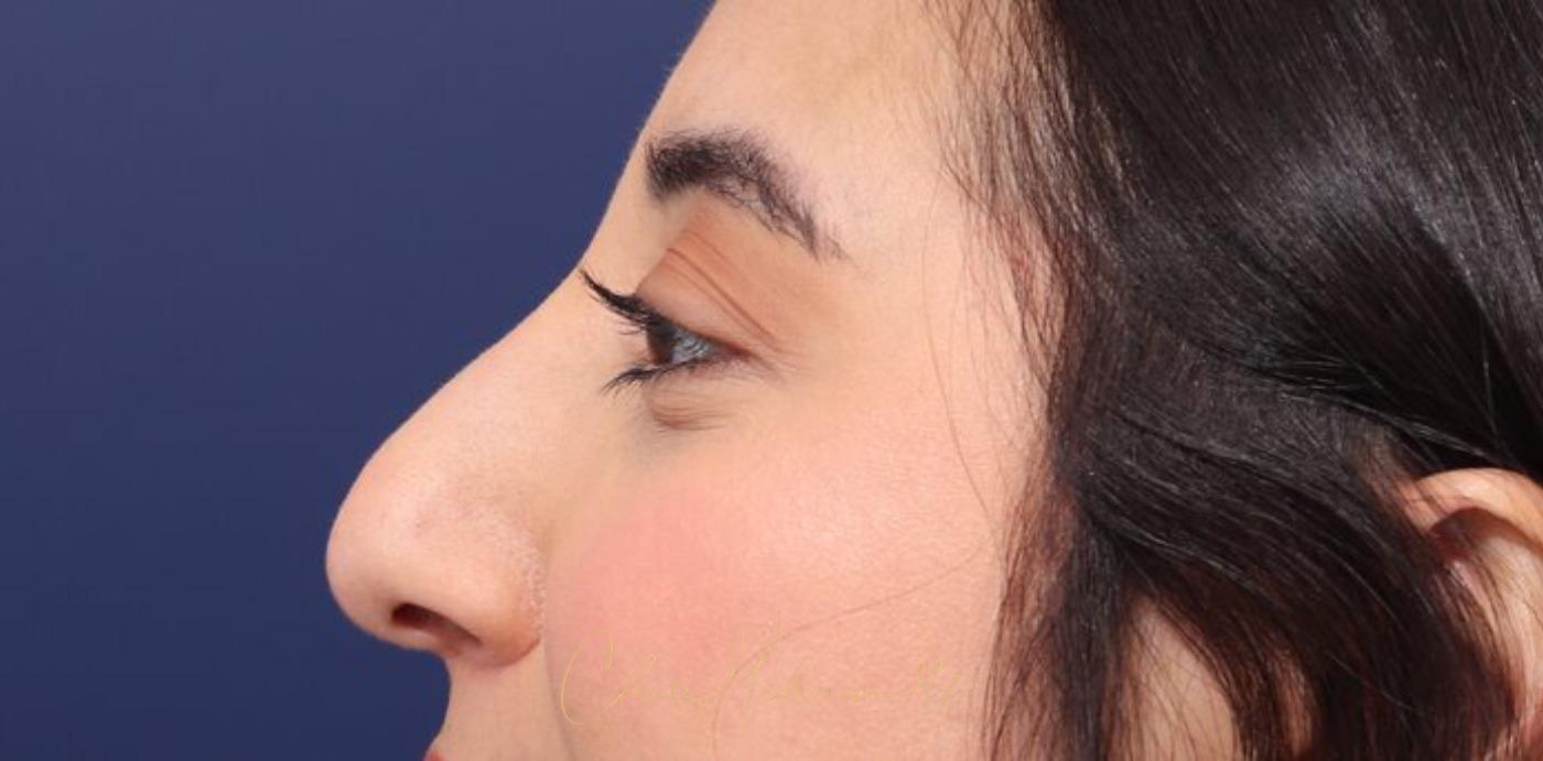 Rhinoplasty Before & After Photo