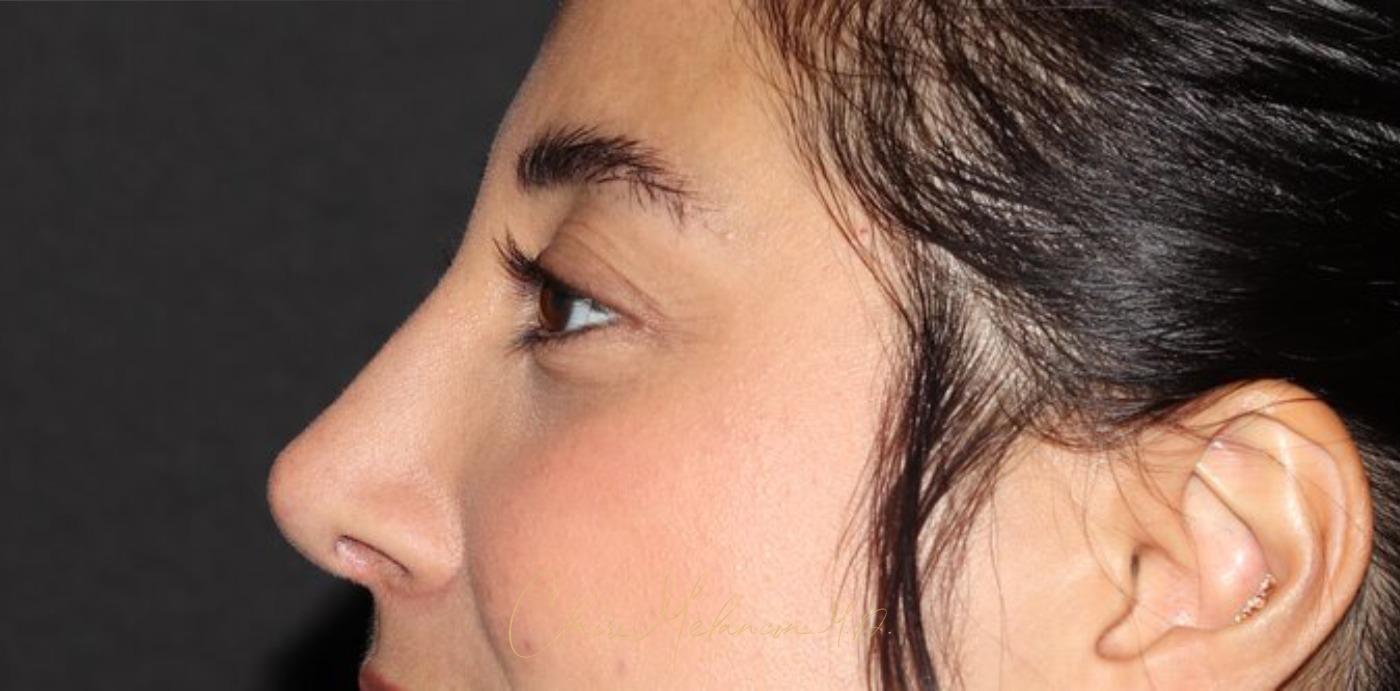 Rhinoplasty Before & After Photo