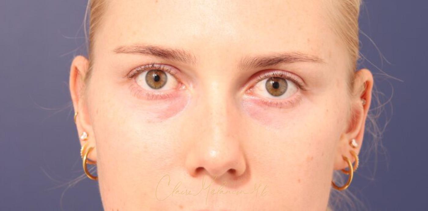 Rhinoplasty Before & After Photo