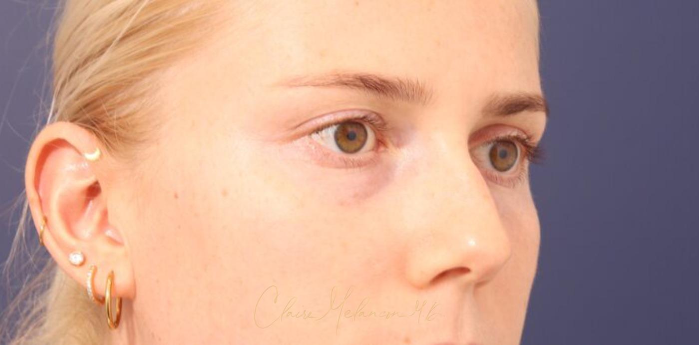 Rhinoplasty Before & After Photo