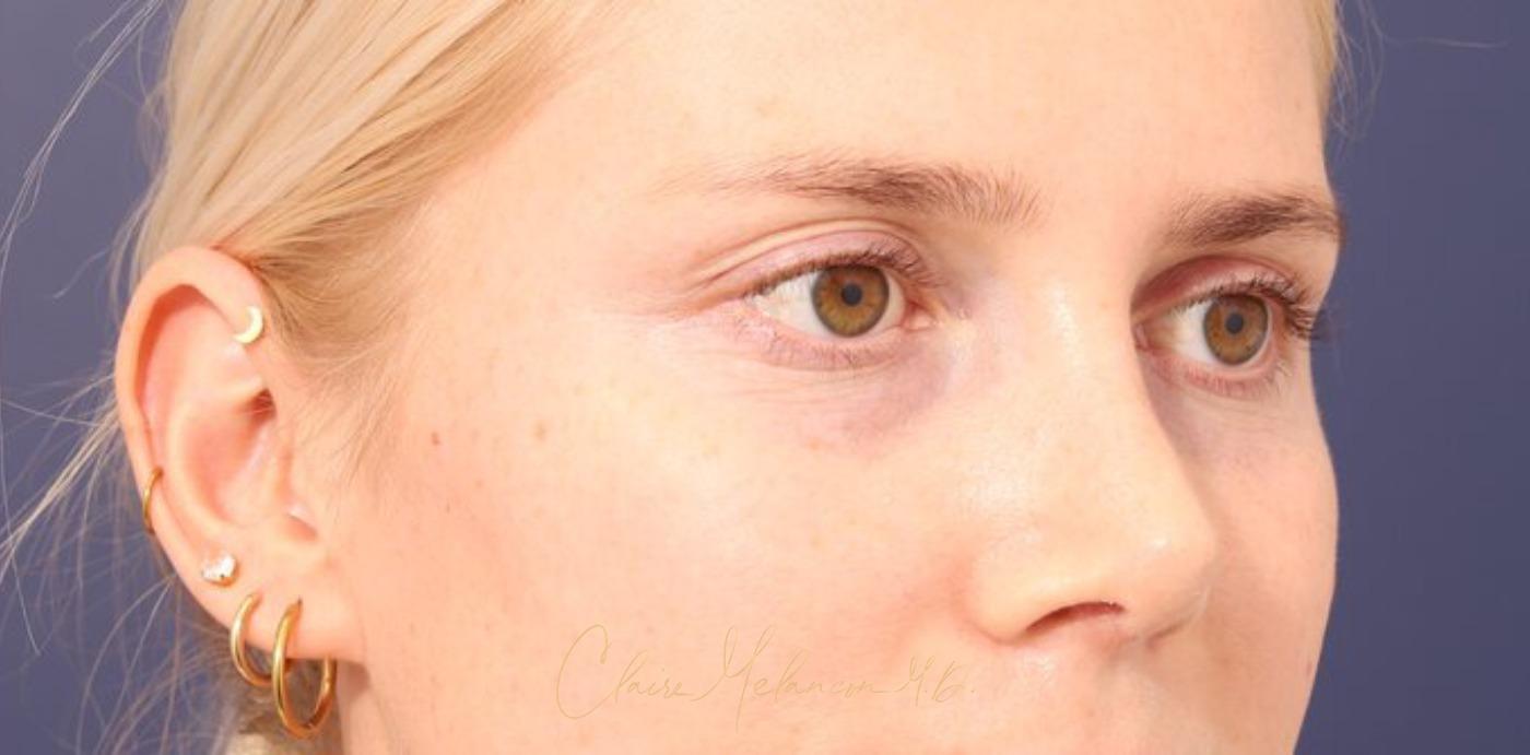 Rhinoplasty Before & After Photo