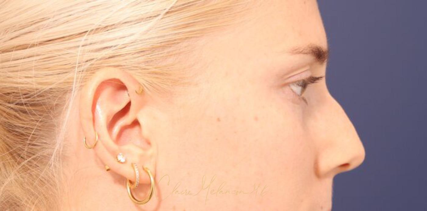 Rhinoplasty Before & After Photo
