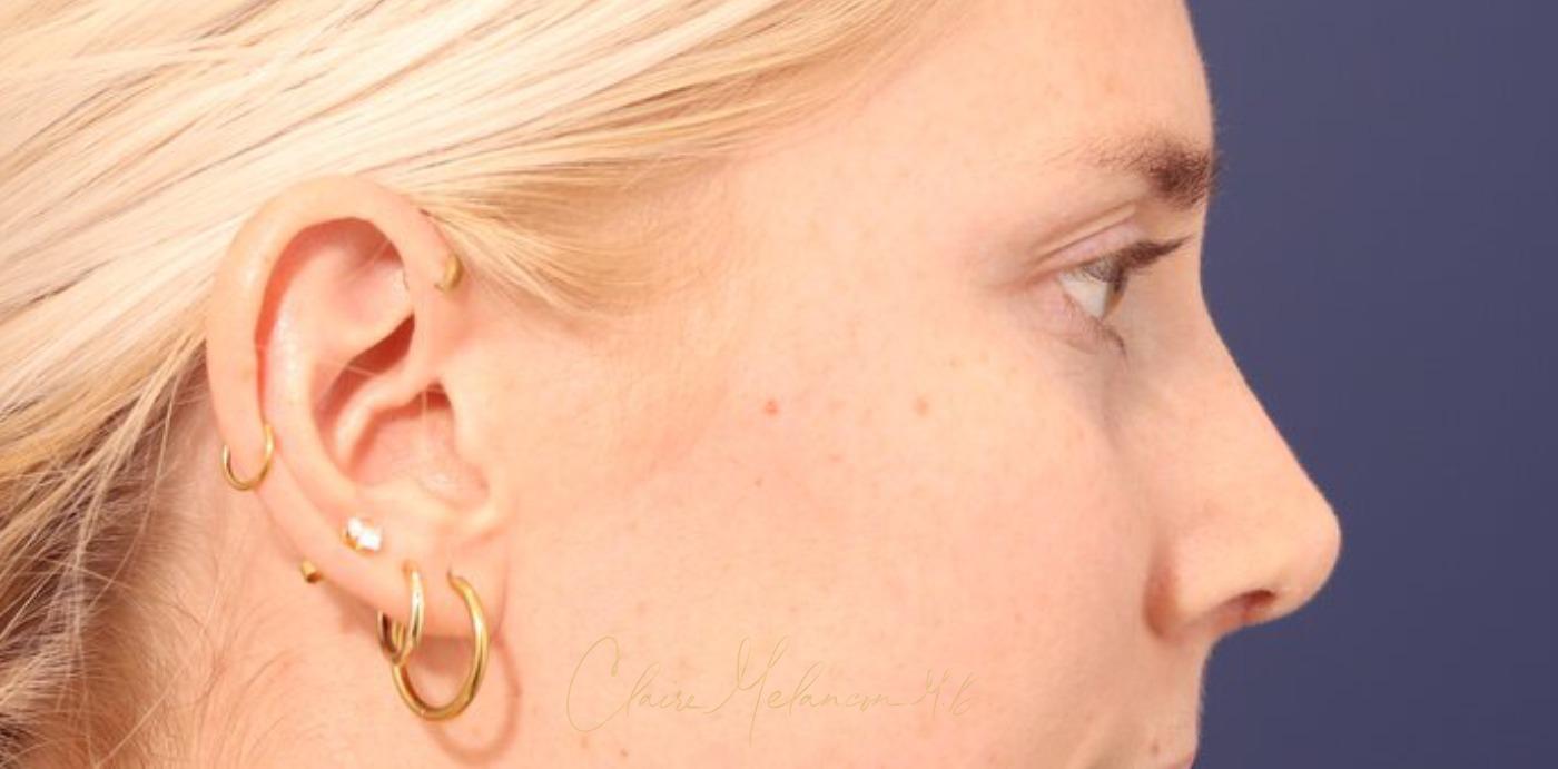 Rhinoplasty Before & After Photo