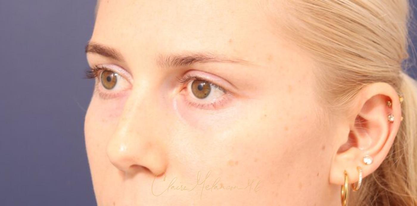 Rhinoplasty Before & After Photo