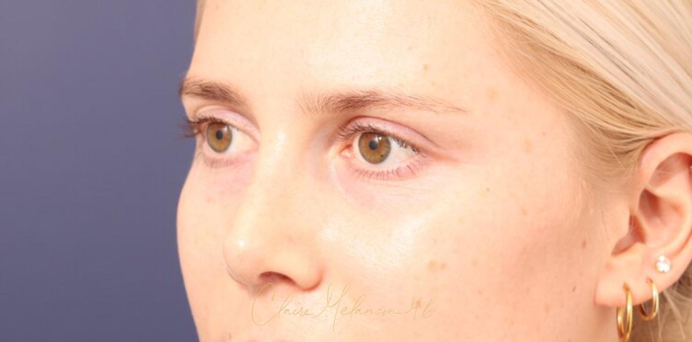 Rhinoplasty Before & After Photo