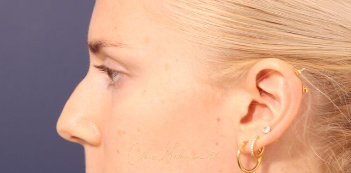 Rhinoplasty Before & After Photo