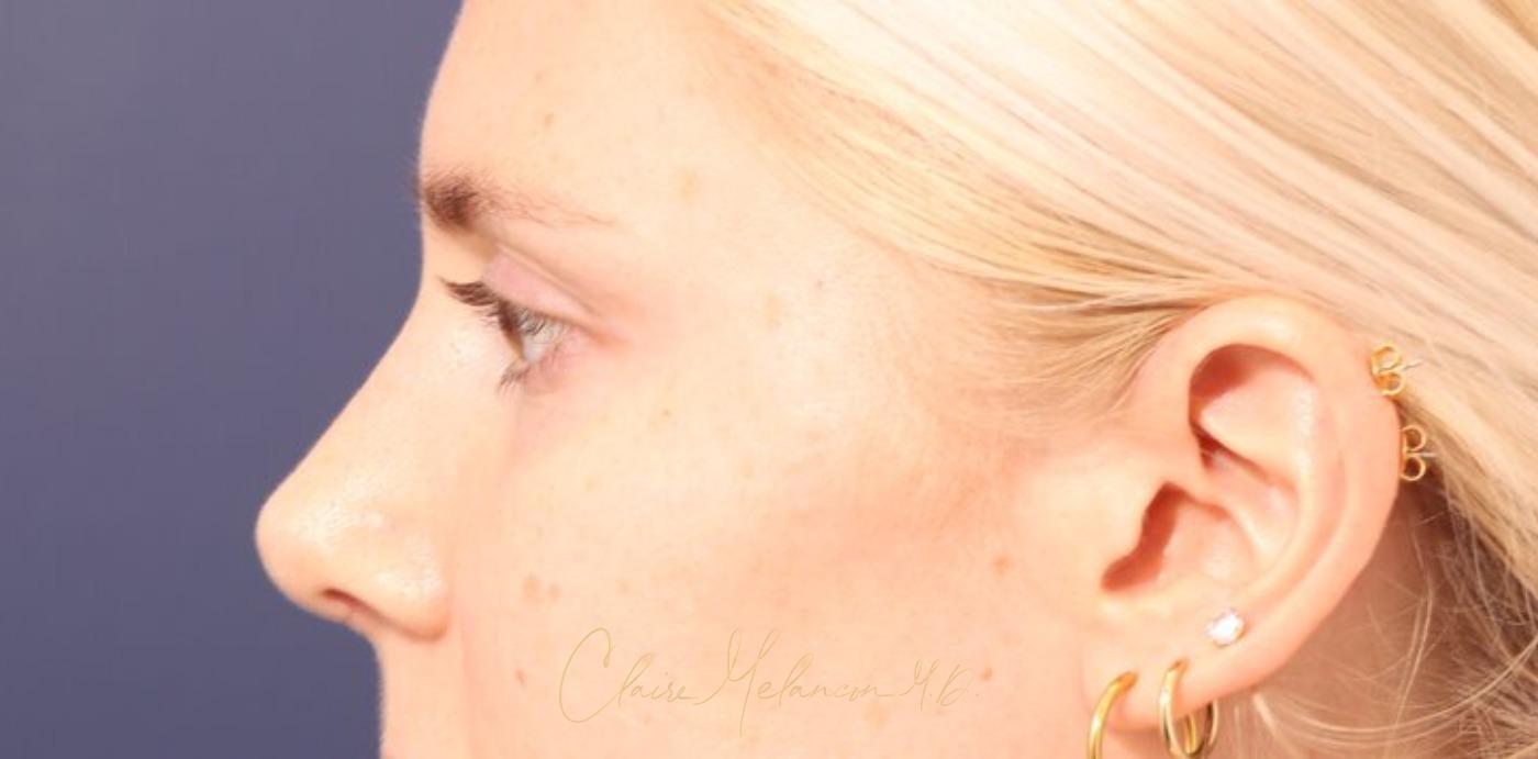 Rhinoplasty Before & After Photo