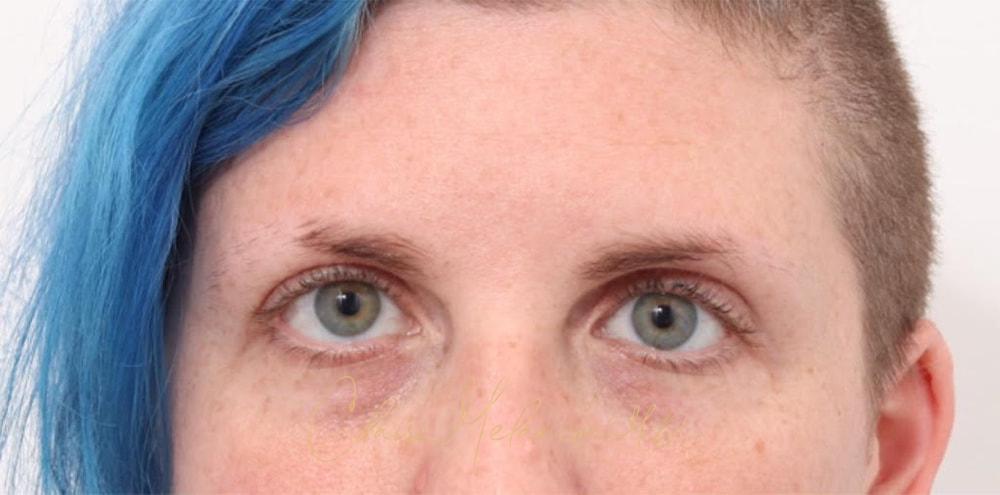 Brow Lift Before & After Photo