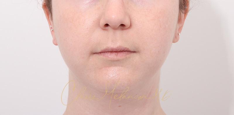 Buccal Fat Removal Before & After Photo