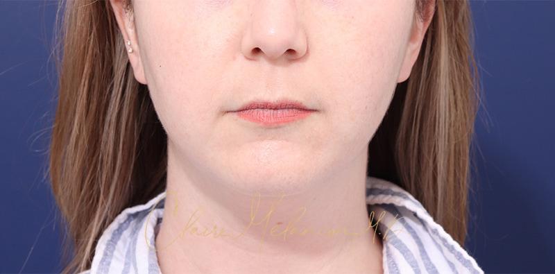 Buccal Fat Removal Before & After Photo