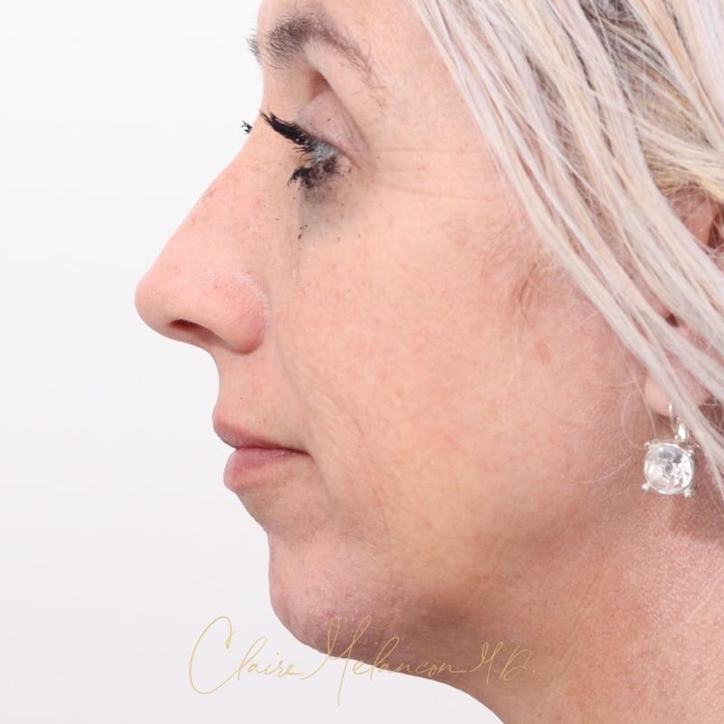 Rhinoplasty and Chin Augmentation Before & After Photo