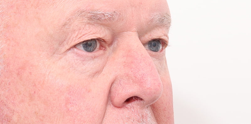 Blepharoplasty Before & After Image