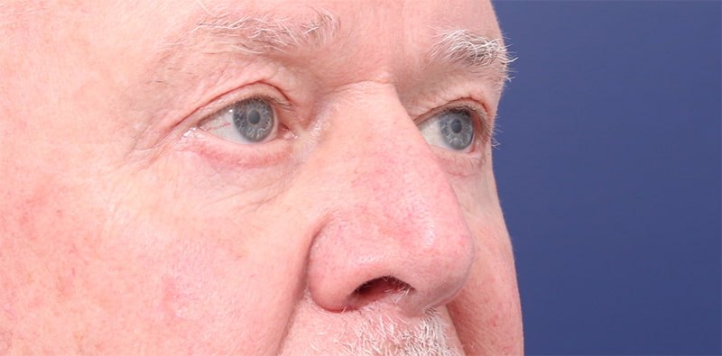 Blepharoplasty Before & After Image