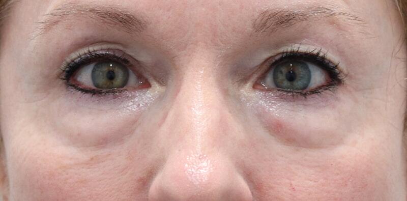 Blepharoplasty Before & After Image