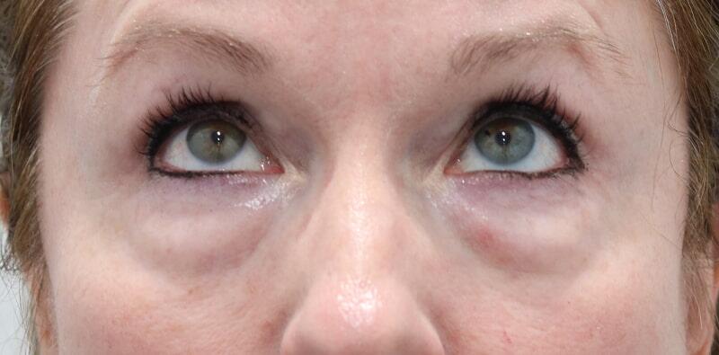 Blepharoplasty Before & After Image