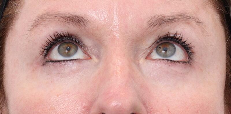 Blepharoplasty Before & After Image