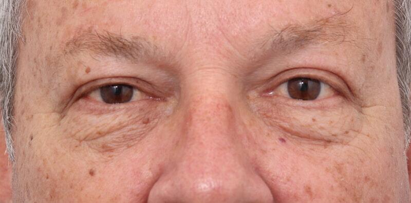 Blepharoplasty Before & After Image