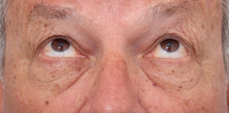 Blepharoplasty Before & After Image