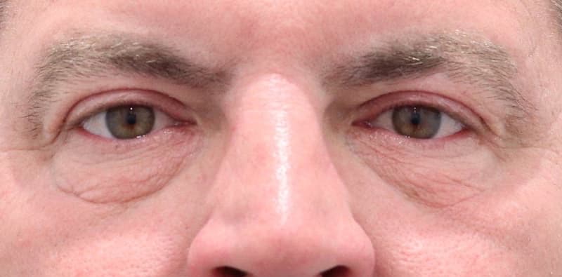 Blepharoplasty Before & After Image