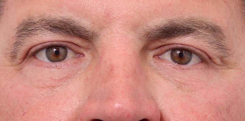 Blepharoplasty Before & After Image