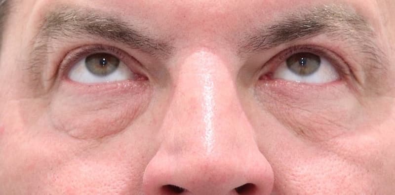 Blepharoplasty Before & After Image