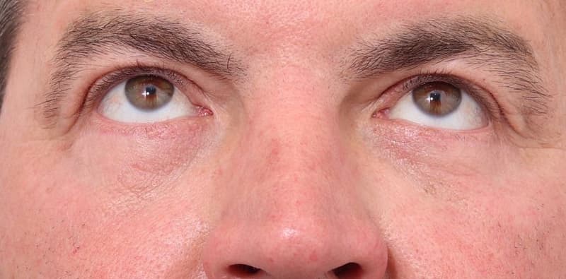 Blepharoplasty Before & After Image