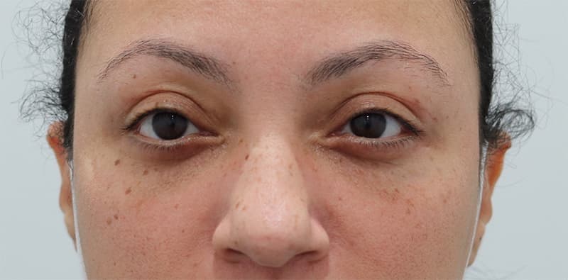 Blepharoplasty Before & After Image