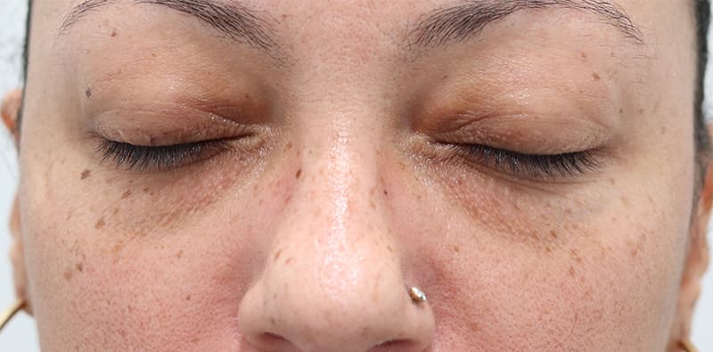 Blepharoplasty Before & After Image
