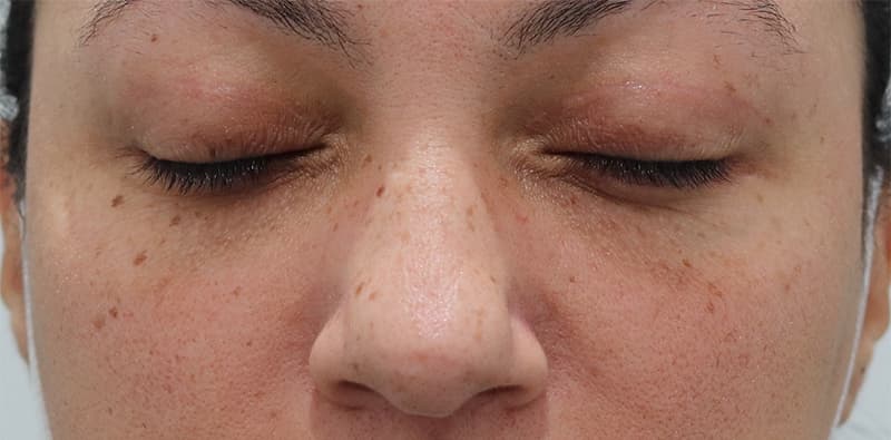 Blepharoplasty Before & After Image