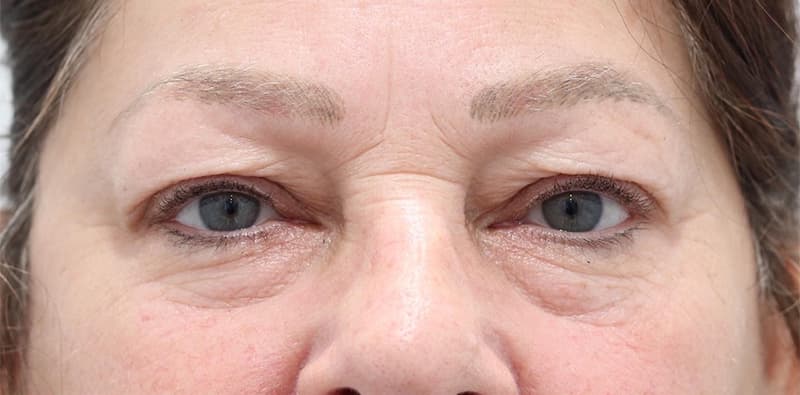 Blepharoplasty Before & After Image