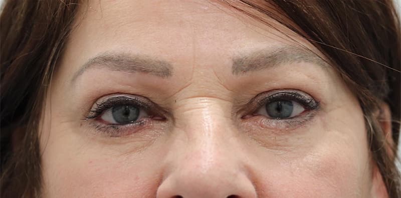 Blepharoplasty Before & After Image