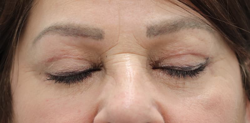 Blepharoplasty Before & After Image