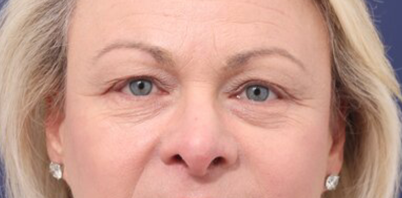 Blepharoplasty Before & After Image