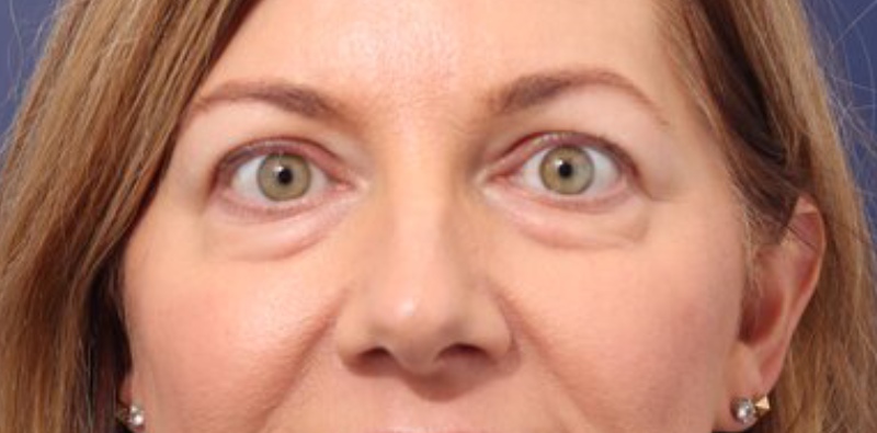 Blepharoplasty Before & After Image