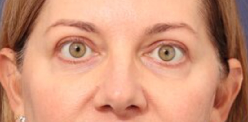 Blepharoplasty Before & After Image