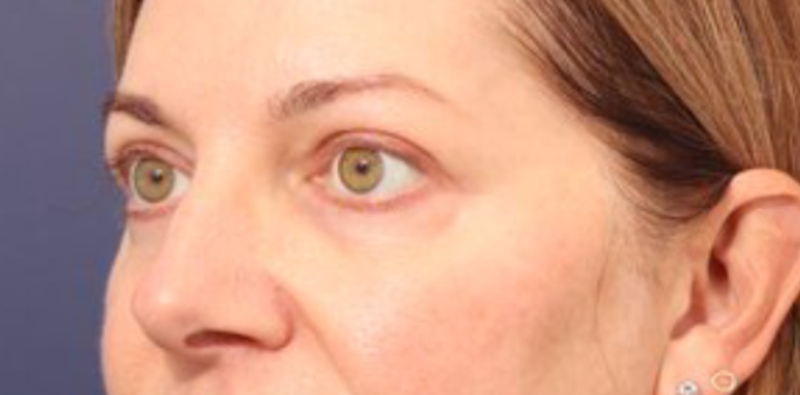 Blepharoplasty Before & After Image