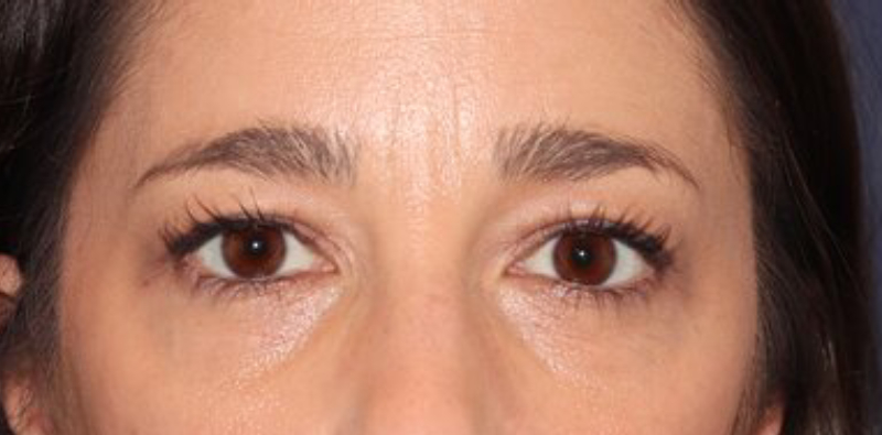 Blepharoplasty Before & After Image