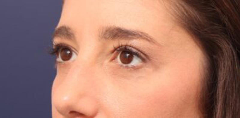 Blepharoplasty Before & After Image