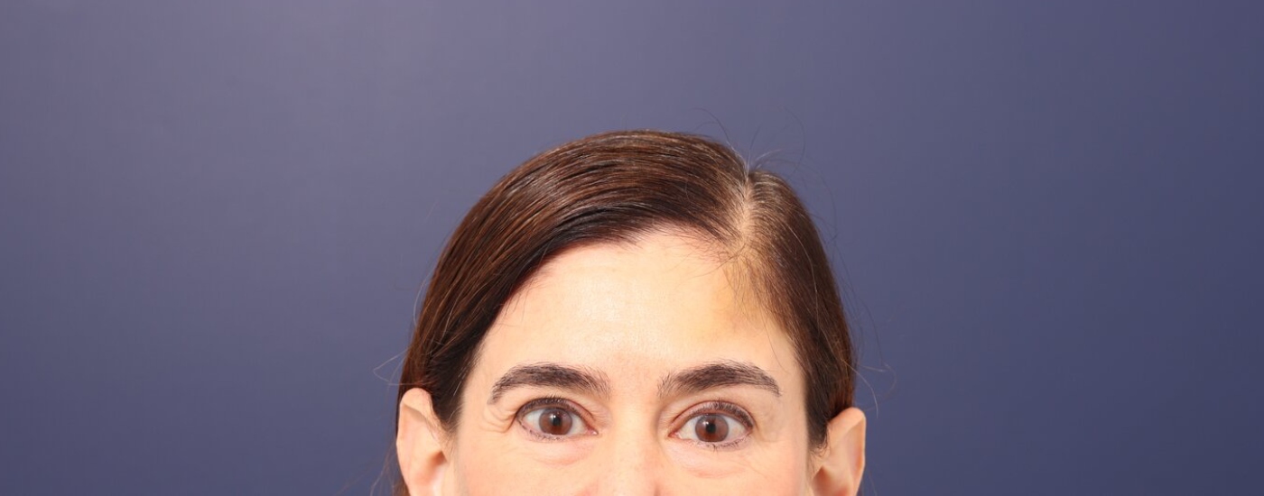 Brow lift Before & After Image